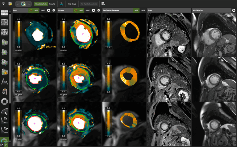 OneVessel RCA Disease A1951